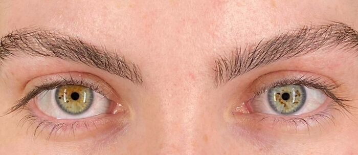 I Have Complete And Sectoral Heterochromia, Along With A Lot Of Eye Freckles
