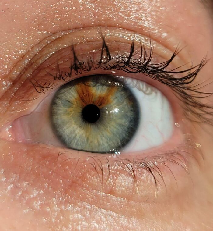 I Have A Birthmark In My Eye. It's Called A Sectoral Heterochromia