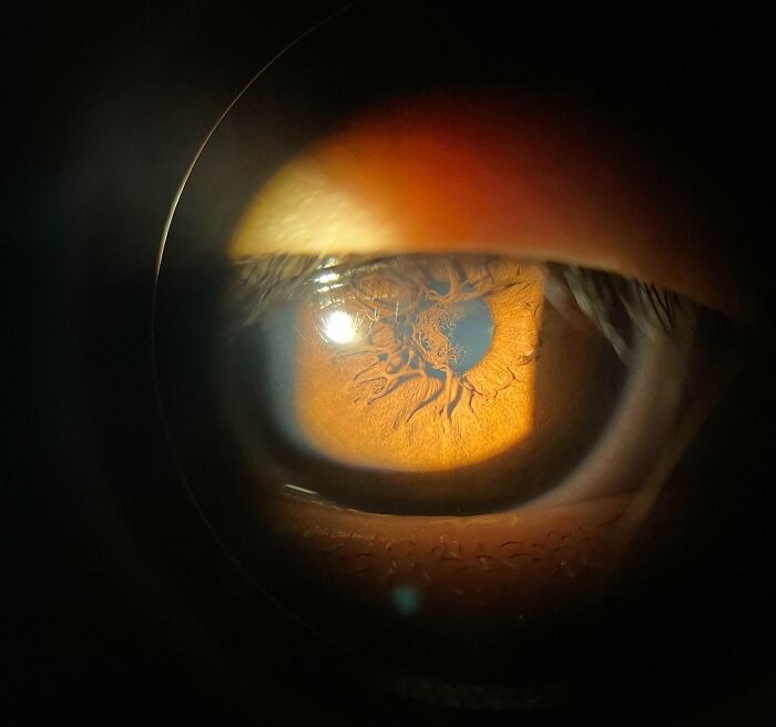 Interesting Iris Pattern (It Doesn’t Affect Vision)