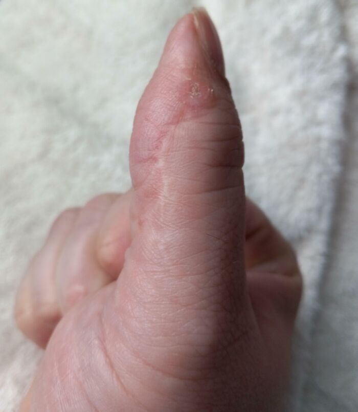 I Was Born With Two Thumbs On My Right Hand. My Extra Thumb Was Surgically Removed When I Was An Infant. The Thumb Nail From The Extra One Now Grows Through My Thumb