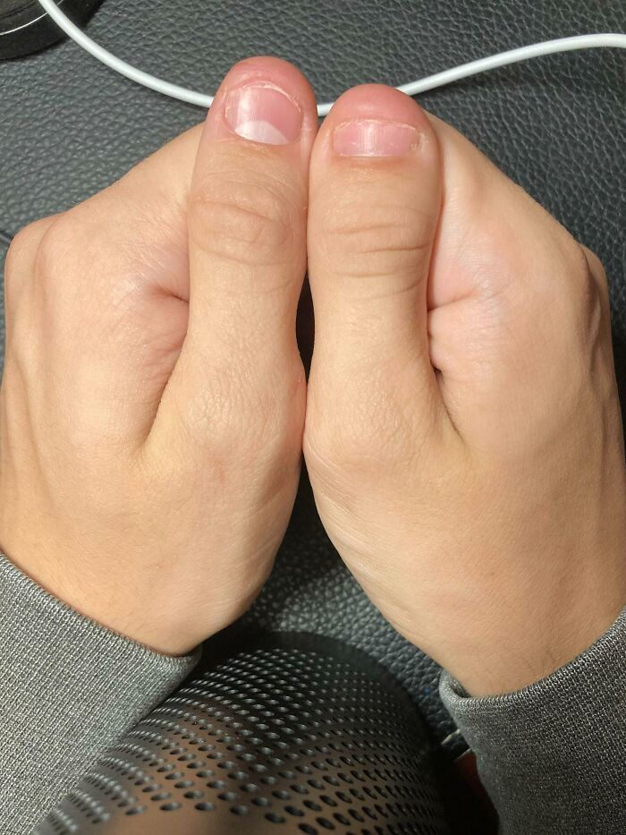 Just Found Out I Was Born With Unilateral Brachydactyly Type D. Here Are My Thumbs