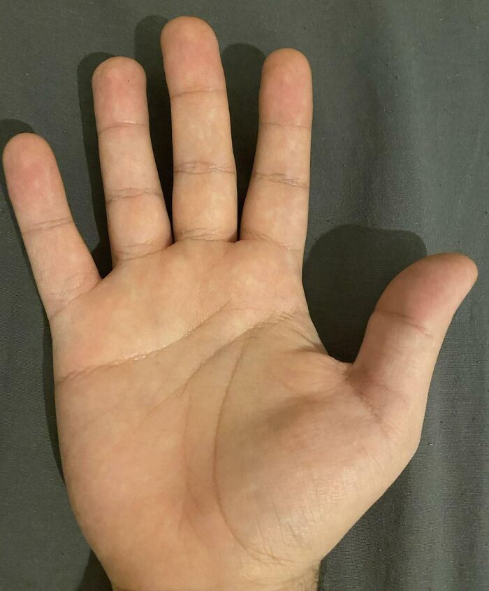 My Right Pinky Finger Has Only One Crease