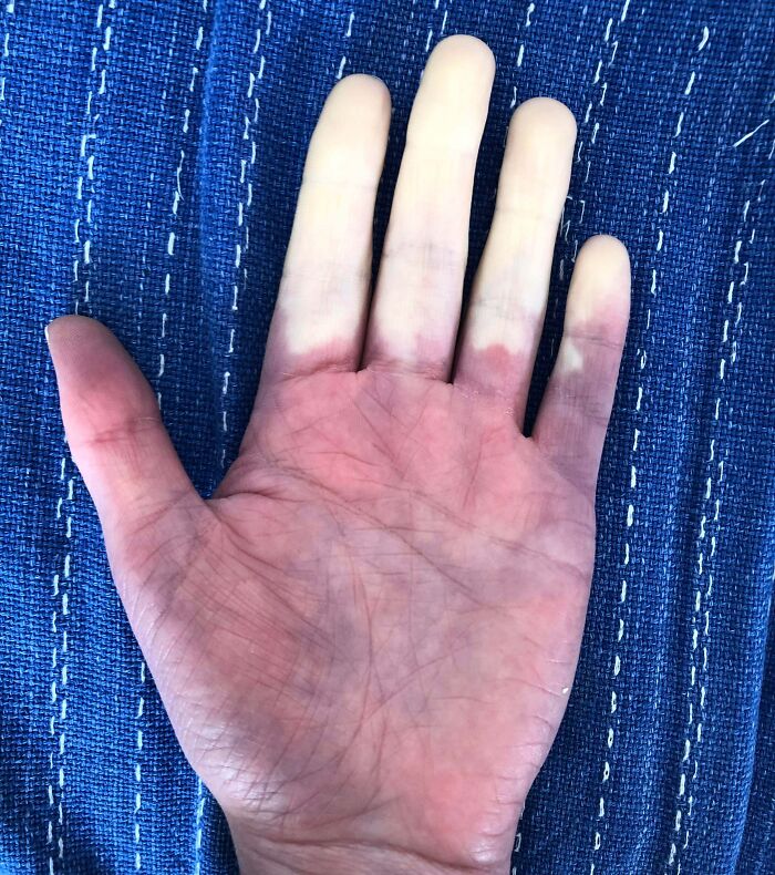 Doctor Told Me That My Raynaud’s Should Be In A Medical Textbook