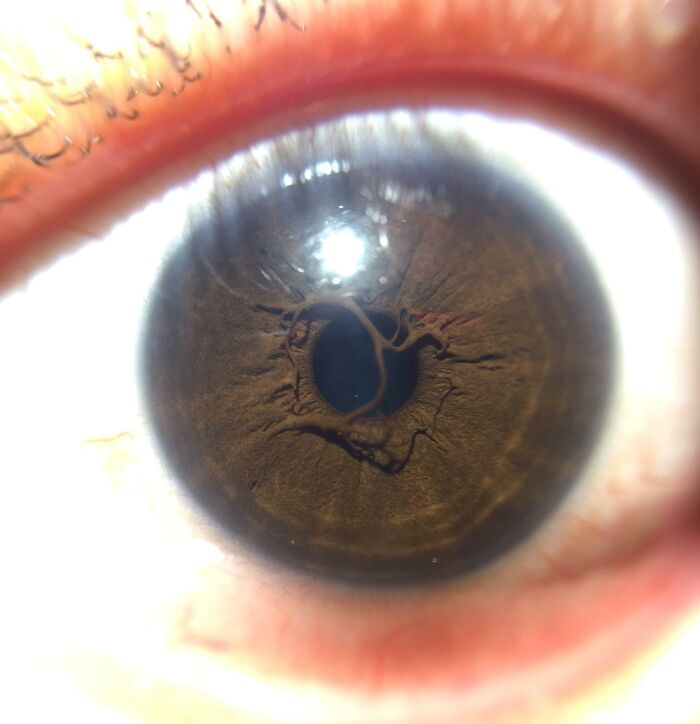 My Girlfriend Has Persistent Pupillary Membrane