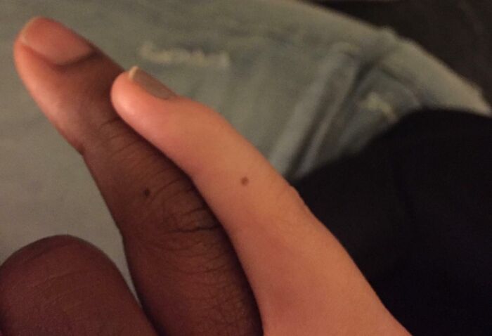 Boyfriend And Girlfriend Have Same Birthmark On The Same Finger