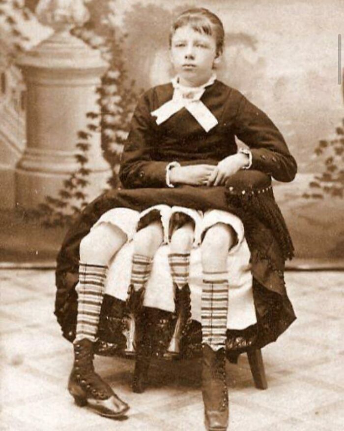 Myrtle Corbin, Who Was Born With Two Sets Of Legs, Two Pelvises, And Two Functional Sets Of Sexual / Reproductive Organs, Taken Betwen 1868-1928