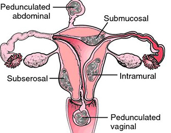 leiomyomas-of-uterus-62e7ea1b96572.jpg
