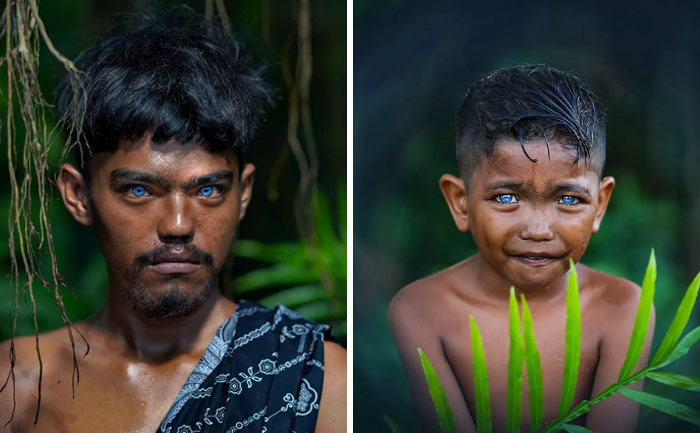 Rare And Unique Genetic Condition Which Is Known As Waardenburg Syndrome. It Can Cause Hearing Loss And Changes In Coloring (Pigmentation) Of The Hair, Skin, And Eyes