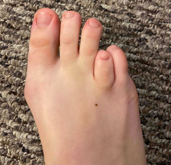 I Was Born With One Toe Missing A Bone. I Have 9.5 Toes Total