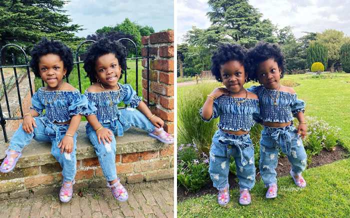 Twin Girls Have Achondroplasia. This Genetic Disorder Is Characterized By A Large Head, Short Arms And Legs, Short Stature, Prominent Forehead, And Flat Nasal Bridge