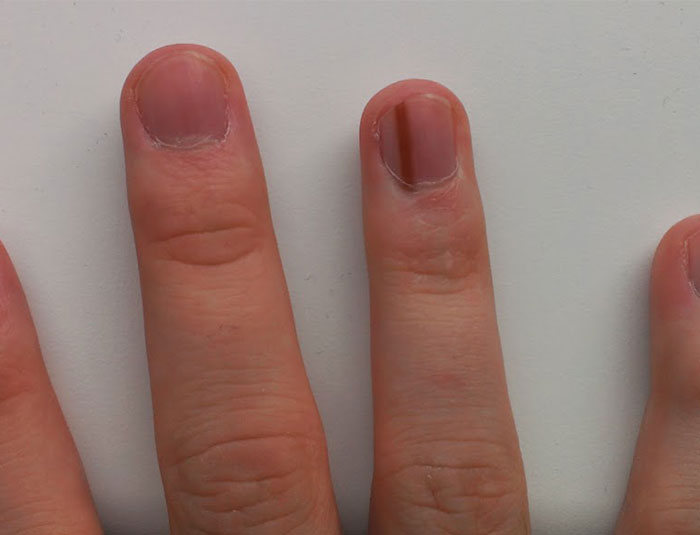 A Birthmark Developed Under The Skin On My Right Ring Finger Where The Nail Is Formed. It Permanently Colors The Nail And Leaves Brown Pinstripe The Width Of The Birthmark