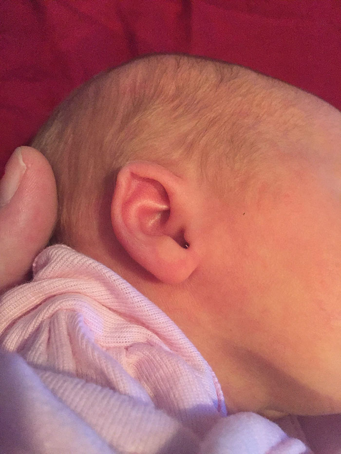 I Had Identical Twin Girls, And One Ear On One Of The Baby Is An Elf Ear