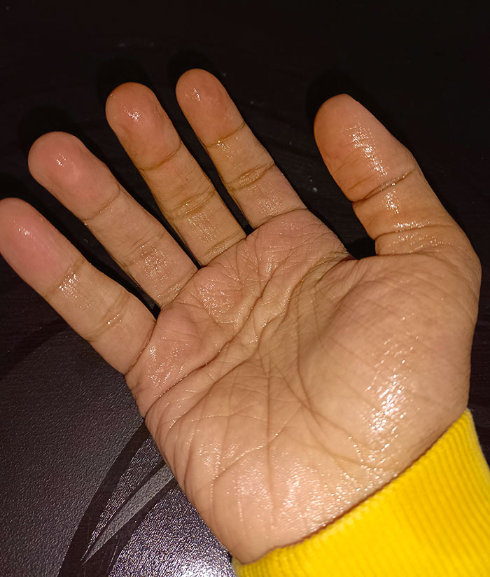 I Have A Rare Condition Called Hyperhidrosis, In Which I Sweat Profusely From My Hand And Feet. It Makes Doing Anything 10 Times Worse
