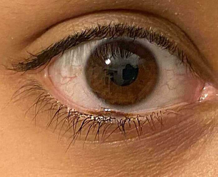I Have A Birthmark In My Eye's Waterline