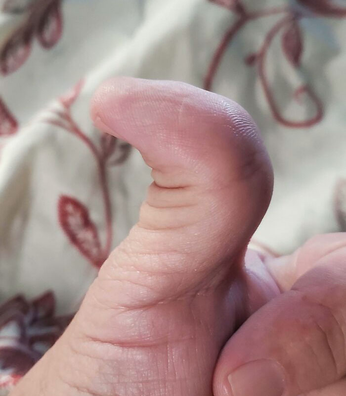 I Have A Genetic Carpenter's Thumb That Allows My Thumb To Bend Backwards As Well As Forwards