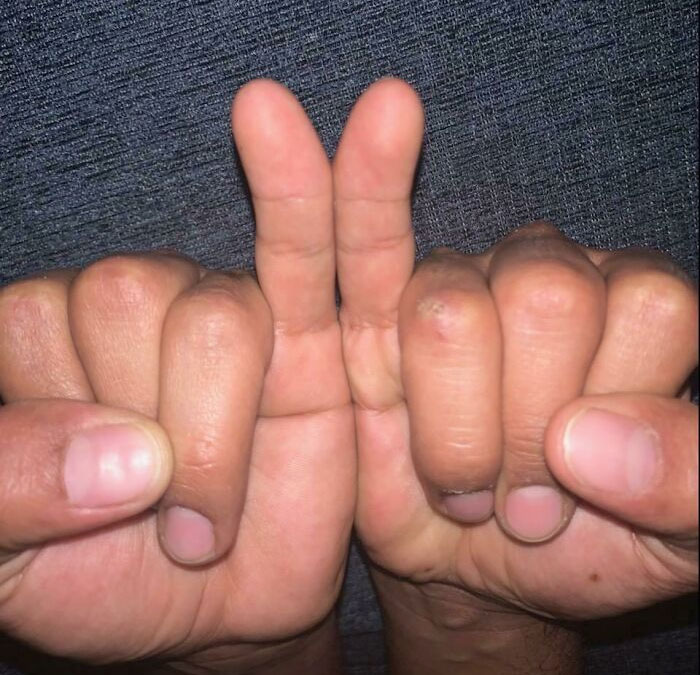 I And Some Members Of My Family Have This Genetic Mutation Called Clinodactyly, Our Pinky Fingers Are Bent Inward