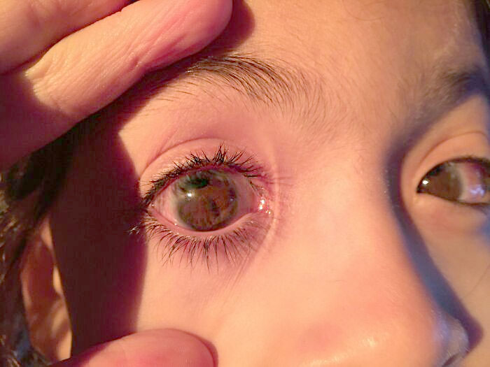 My Son's Pupils Are Way Off Center (Towards The Top Of His Irises) And Neither Of Them Are Round