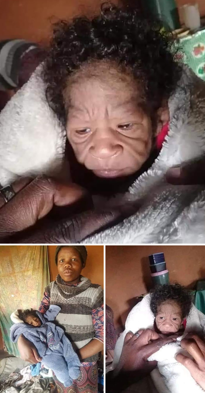 A 2-Month-Old Baby Looks Like A 70-Year-Old Man