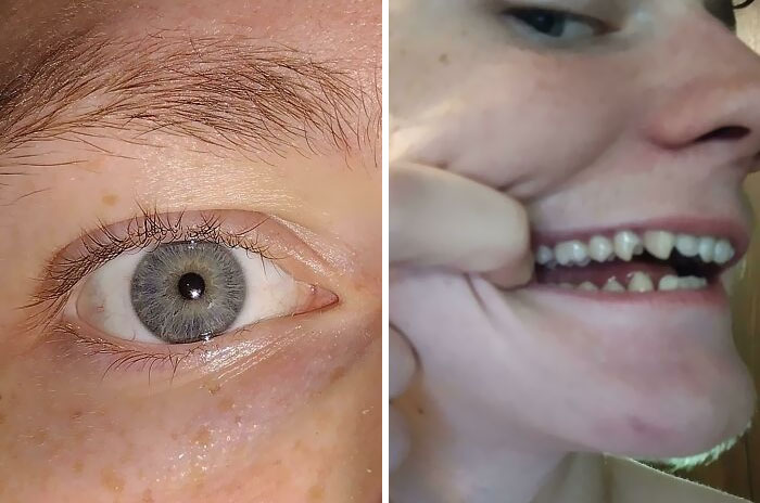 I Have Central Heterochromia And Exaggerated Canines And Premolars