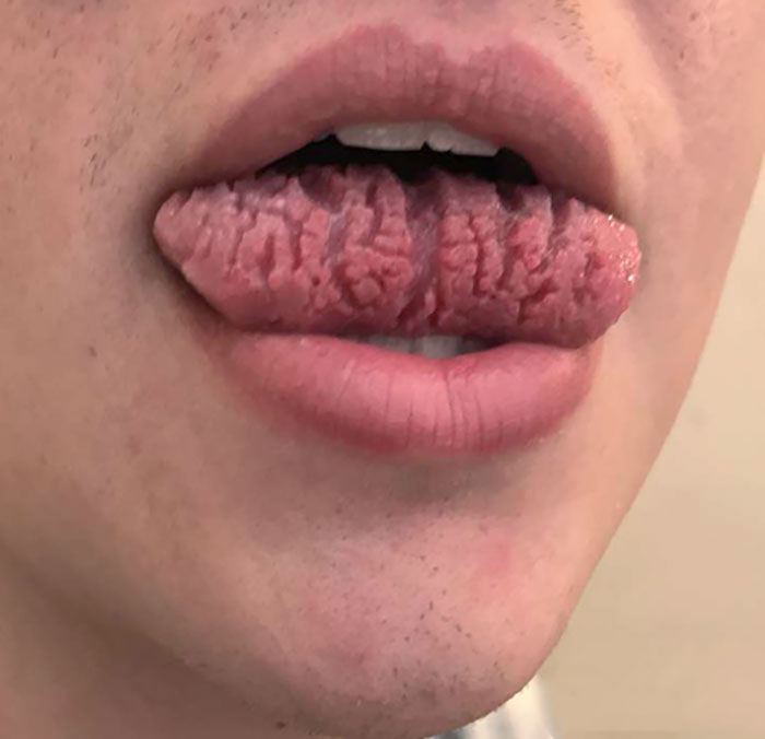 My Friend's Genetic Tongue Condition