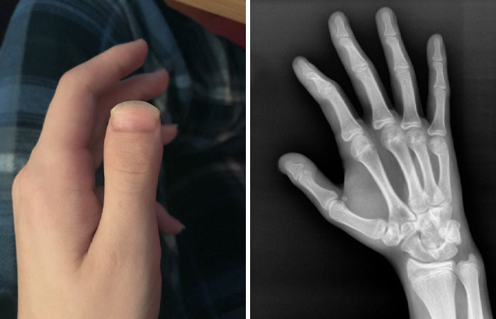 I Have An Uncommon Genetic Deformity Called Brachydactyly Type-D, Making The End Bone On Both Thumbs Short