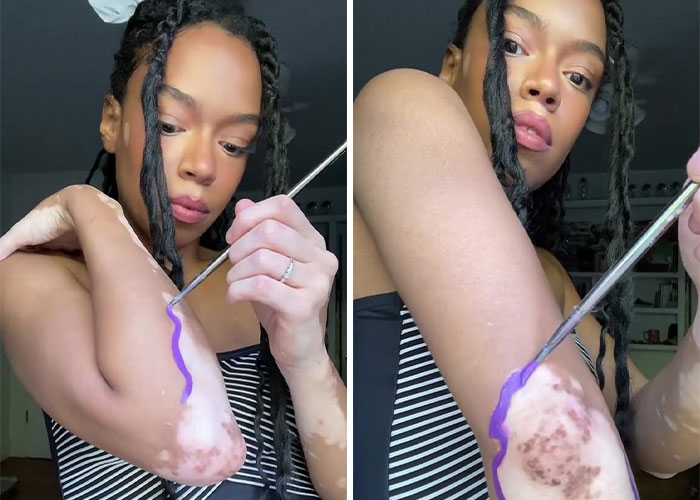 This Woman With Vitiligo Is Highlighting Her Spots, People Applaud Her For Embracing Her Beauty