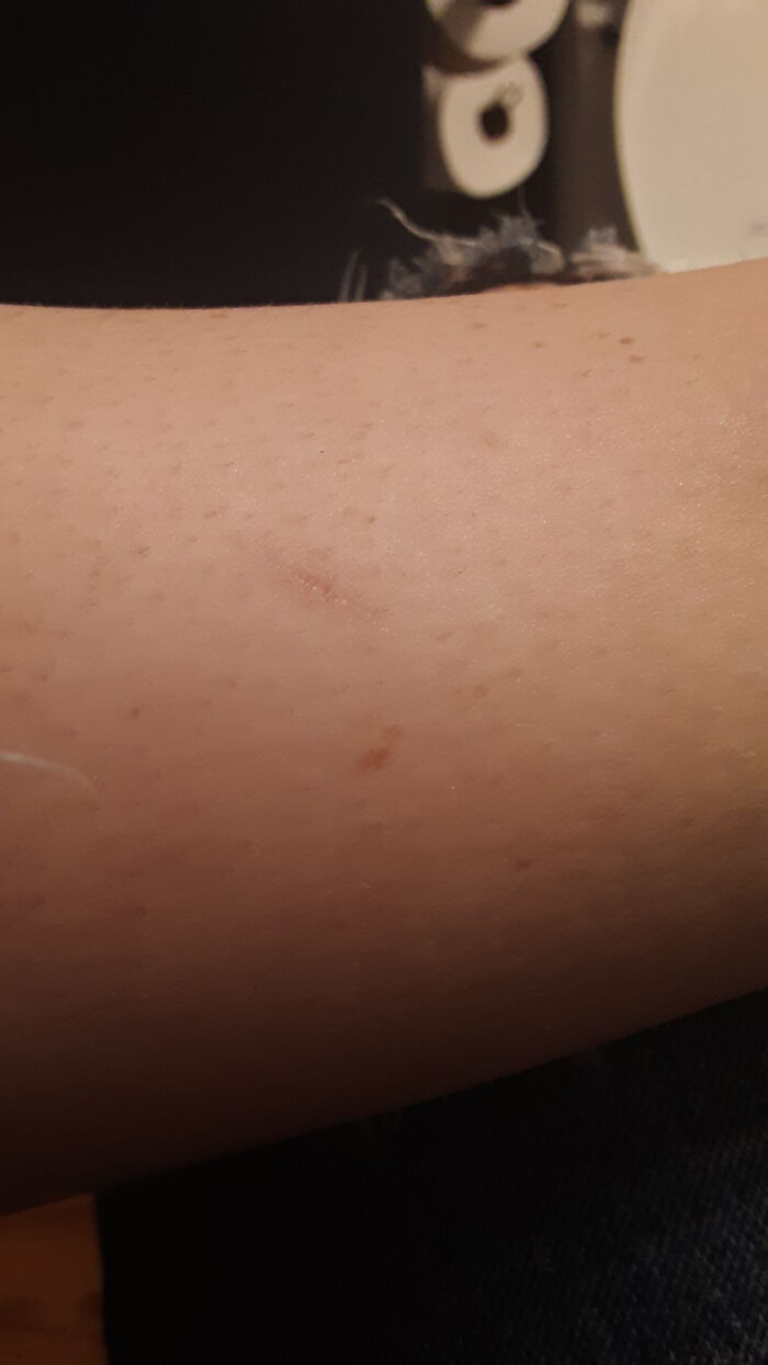 These Two On My Leg That I Got Almost Exactly A Year Apart At Summer Camp, Same Place, Dropping A Power Tool On The Same Spot On My Leg