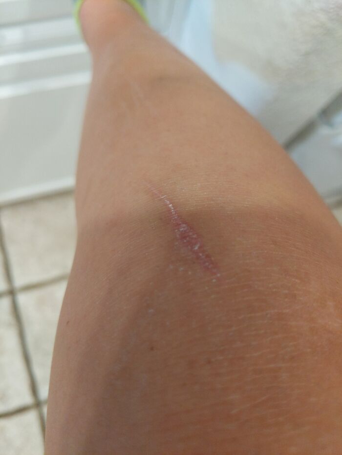 My Whole Knee Is One Fading Scar, That's What The Bumps Are, But The Big Scar Is When I Tripped, On A Rock, In The River