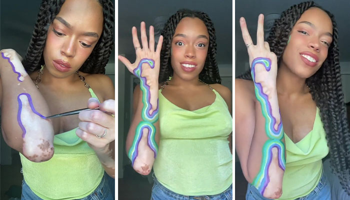 This Woman With Vitiligo Is Highlighting Her Spots, People Applaud Her For Embracing Her Beauty