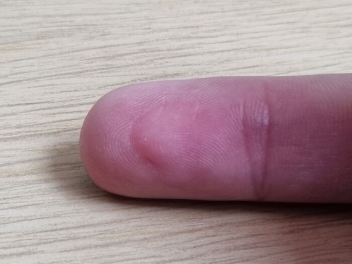 Playing With A Pair Of Secateurs As A Child And My Friend Snipped My Finger With Them