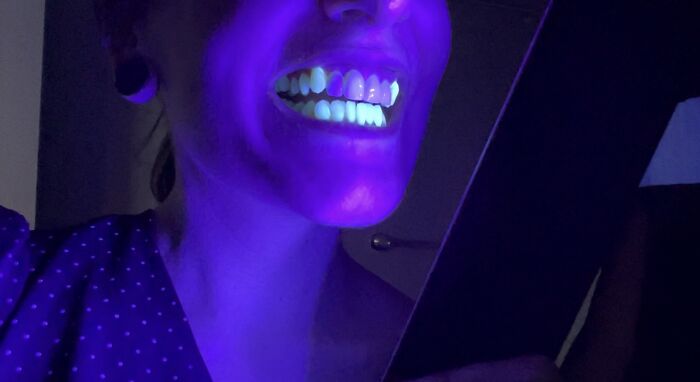 I Found Out My Veneers Don’t Glow In Blacklight