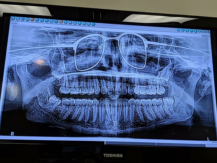 El otro día me hicieron una radiografía panorámica de mis dientes. El dentista se olvidó de quitarme las gafas