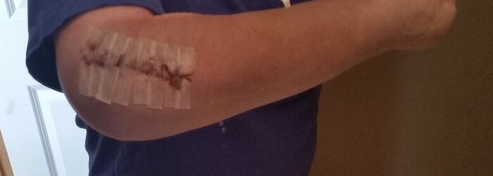 Walked Dogs Wearing Sneakers Then Hit Black Ice. Broke Elbow