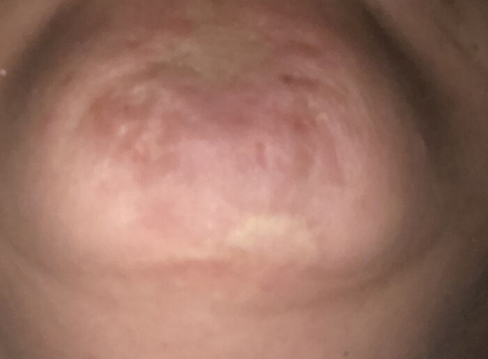 My Chin. Fell On Side Of Bathtub At 3. Tripped On Sidewalk At 6. Bike Wreck At 12