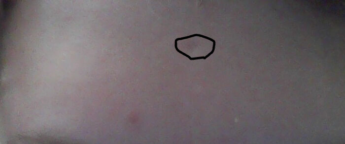 Kinda Hard To See But I Fell On A Thumbtack As A Baby And It's Still There After Fifteen Yrs