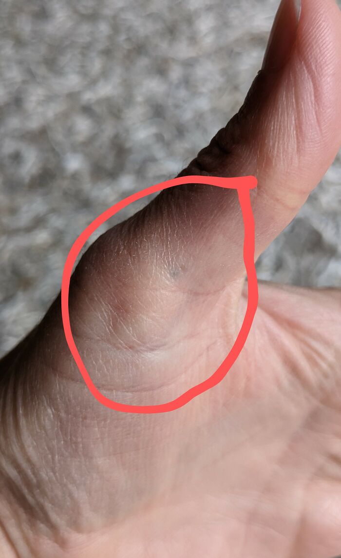 My Tattoo, Courtesy Of An Uncapped Fountain Pen In A Flimsy Pencil Case Thrown At Me By Mindy Basran, Aged 10