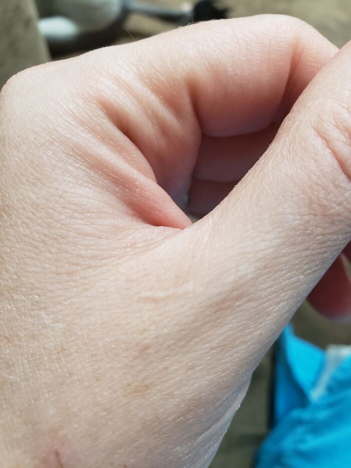 Scratched My Hand On The Corner Of The Doghouse When I Was 12, It Didn't Even Bleed