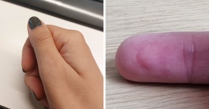 Hey Pandas, What Is Your Dumbest Scar And How Did You Get It? (Closed)