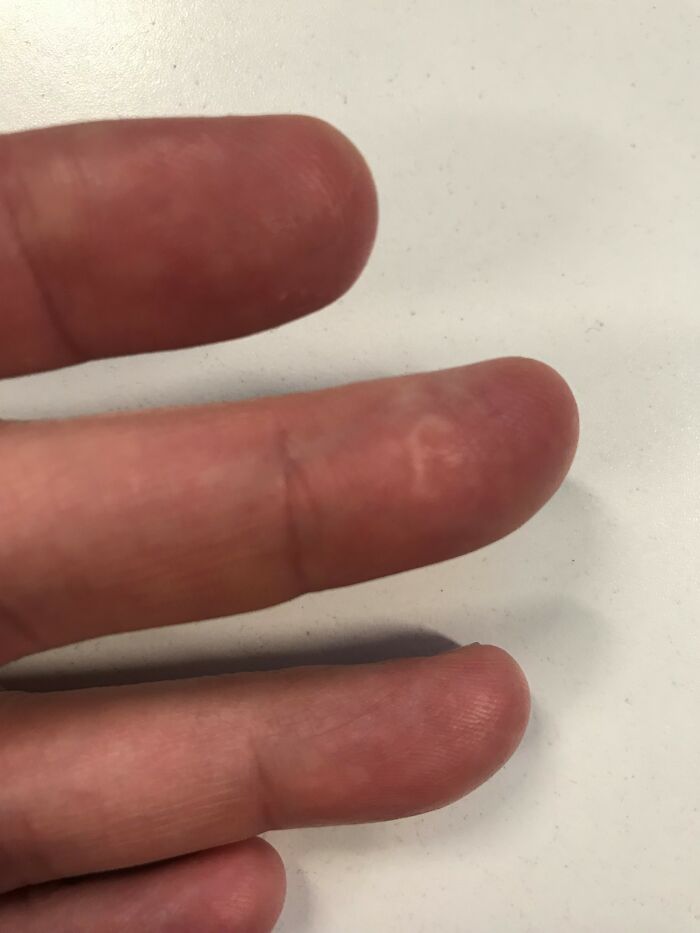 This Is From Holding Something I Was Forcibly Trying To Open With A Phillips Screwdriver