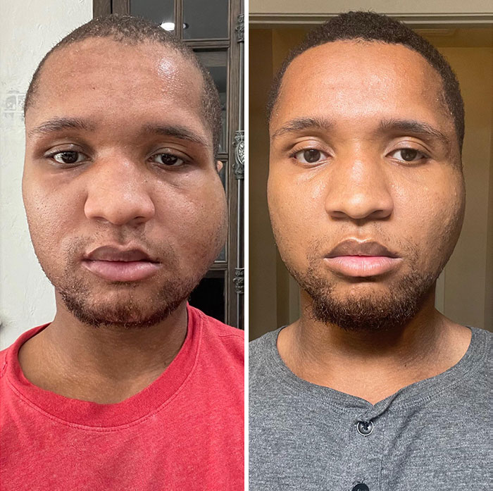 Quería compartir el progreso de mi hinchazón tras la reconstrucción facial