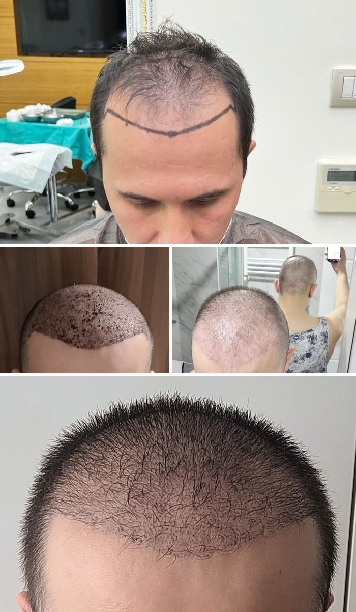 Hair Transplant (98 Days Of Progress)