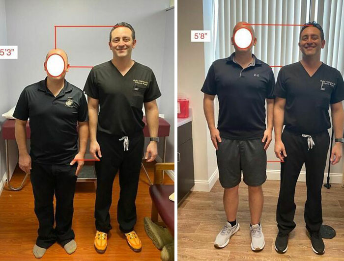 Leg-Lengthening Surgery Is Available In More Than A Dozen Countries, With Some Patients Able To Increase Their Height By Up To Five Inches - 13cm. Before And After