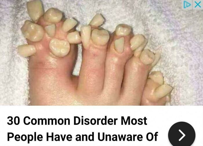 This Clickbait. Yes, So Many People Have Toe Teeth