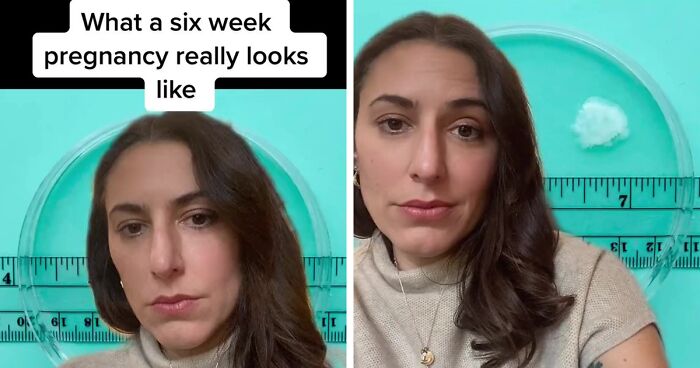 Some Anti-Abortion Folks Were Not Ready To See That A Pregnancy At 6 Weeks Doesn’t Have A Growing Embryo And Is Only Bodily Tissue