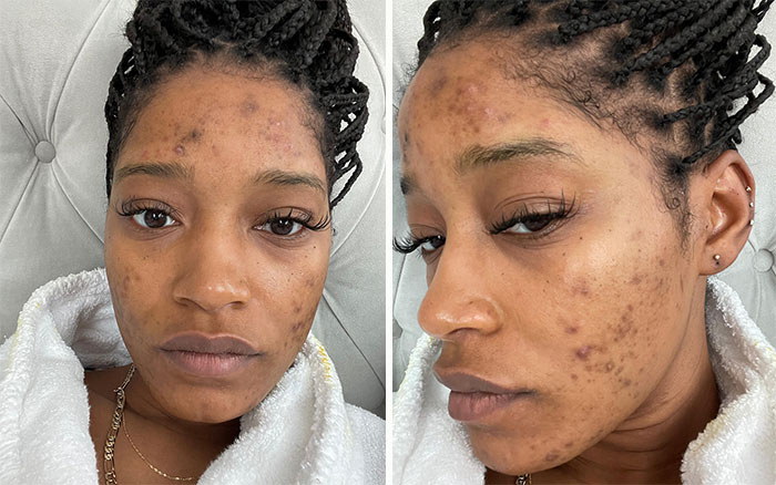When Keke Palmer Shared — And Continued To Update Us On — Her Experience With Polycystic Ovary Syndrome (PCOS) And How It Affects Her Skin