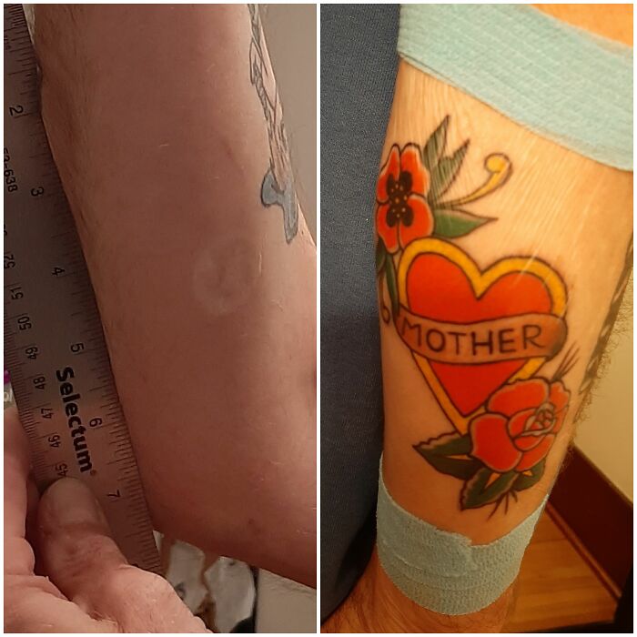 Before And After Of A 20yo "Drunken Shenanigans" Scar. My Mom Always Hated It! The Scar Is Under The Little Poppy