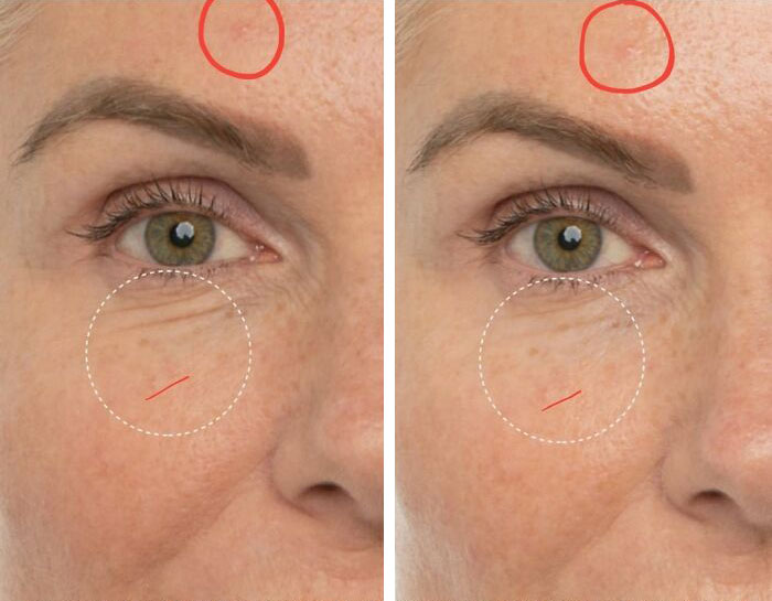 Before And "After". Based Off An "8 Week Study", Yet Has 3 Pimples In The Exact Same Spot With No Change In Size Or Color. I Really Hate Misleading Ads