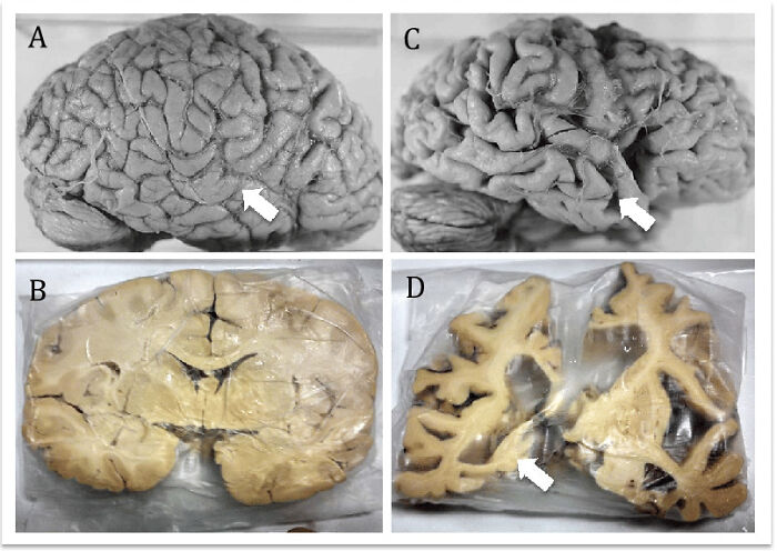 Comparación neuroanatómica entre el cerebro normal y el de la enfermedad de Alzheimer