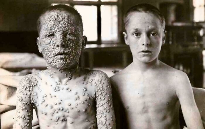 Estos dos niños habían estado expuestos a la misma fuente de viruela. Uno había sido vacunado, el otro no