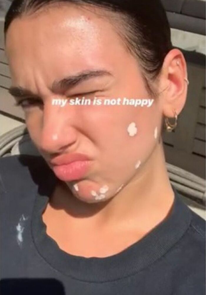 When Dua Lipa Shared This Selfie Of Her "Unhappy Skin"